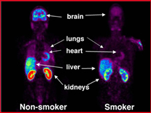 Whole body PET scans showing the distribution of radiolabeled monamine oxidase in one of the nonsmokers and one of the smokers. Red is the highest radiotracer concentration; purple is the lowest. Images are scaled so that they can be compared directly.