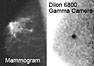 The mammogram of a patient's right breast shows dense tissue that was considered normal but was being monitored in yearly mammograms. The BSGI image taken with the Dilon 6800 Gamma Camera reveals the cancer missed by the mammogram.